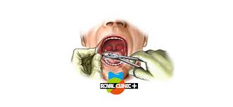 سهل انگاری عجیب یک پزشک ؛ پانسمانی که در حلق نوجوان برازجانی جای ماند!+جزئیات